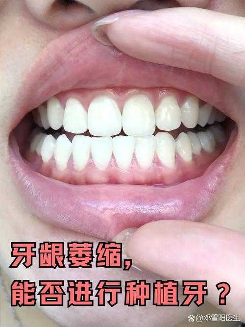 牙齿矫正后牙龈萎缩图，为何会出现牙龈萎缩？-图3