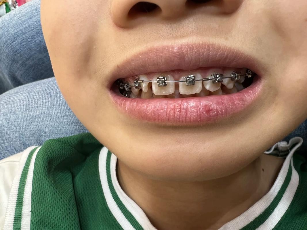 牙齿矫正一般几个月能开始看到效果？之后会越来越明显吗？-图2