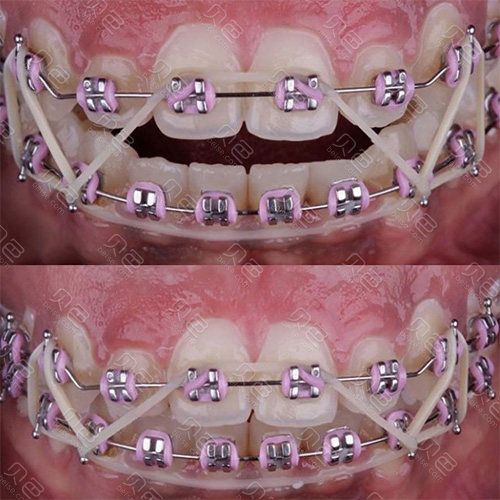 牙齿开合矫正方法如下-图3