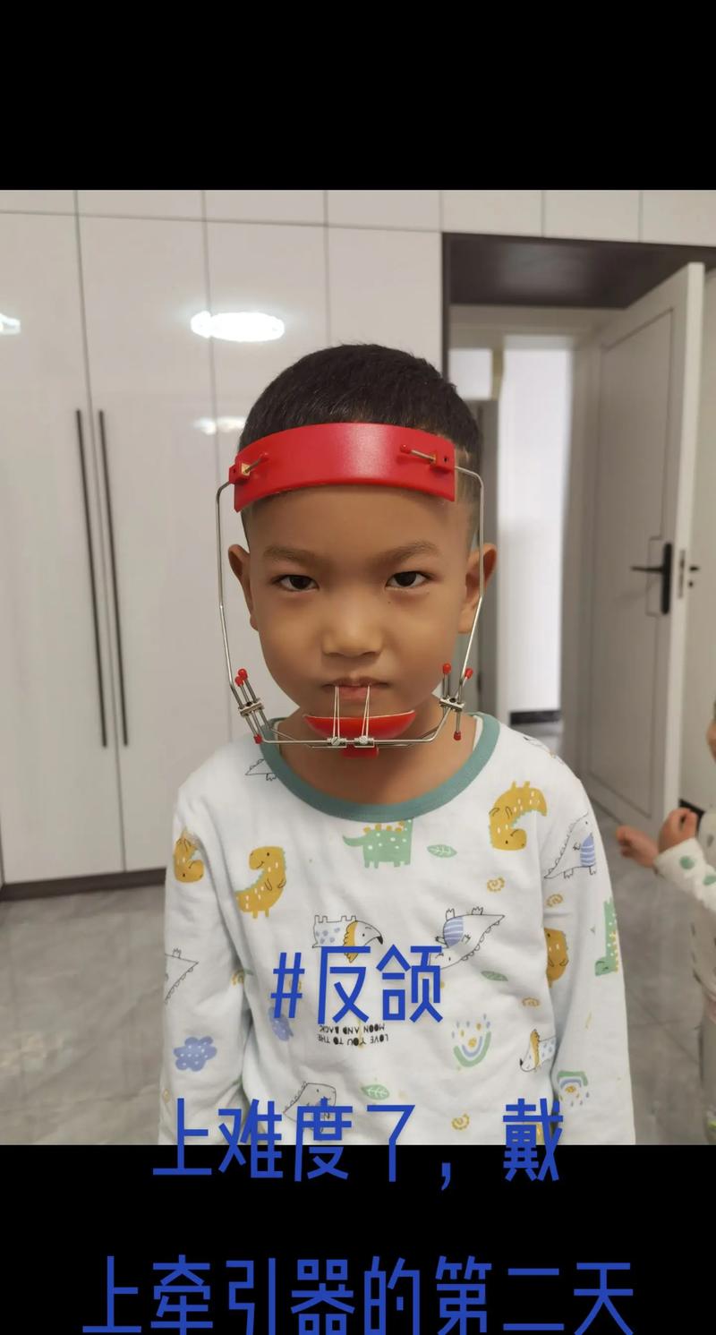 矫正牙齿用的头帽怎么戴才有效？-图2