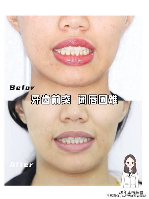 嘴前突 矫正牙齿案例-图1