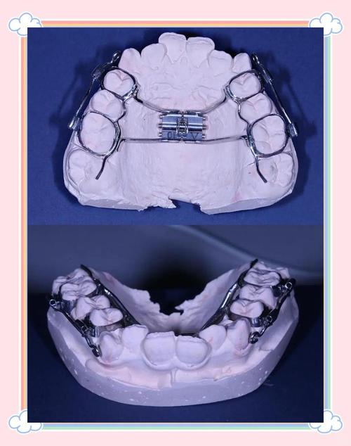 隐形矫正牙齿视频教程能自己完成整个矫正过程吗？-图1