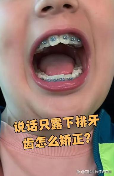 只矫正下排牙齿可以吗？会不会影响上下牙咬合效果？-图3