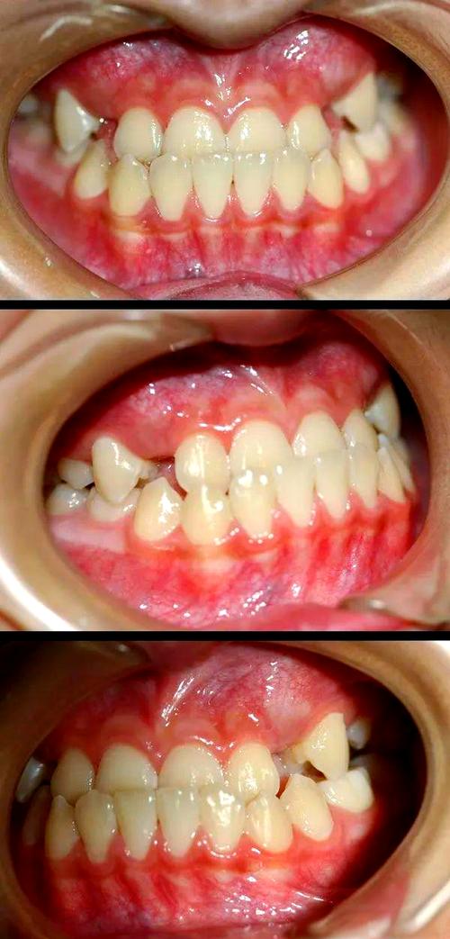 天包地矫正效果图能反映真实矫正效果吗？-图3