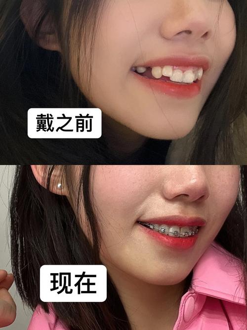 成年人矫正牙齿还来得及吗？年龄不是障碍？-图2