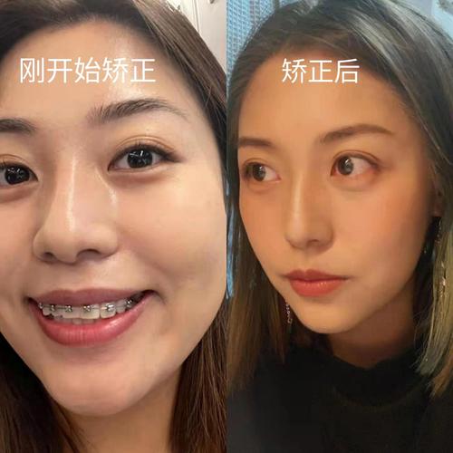 25岁矫正牙齿还来得及吗？-图2