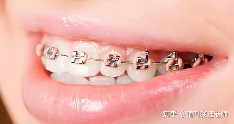 22岁矫正牙齿来得及吗？成年人还有机会吗？-图2