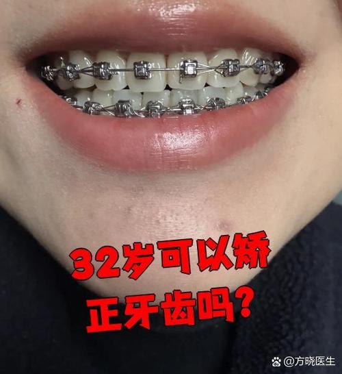 32岁还能矫正牙齿么-图1