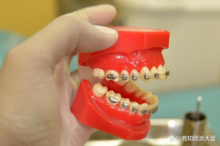 32岁还能矫正牙齿么-图2