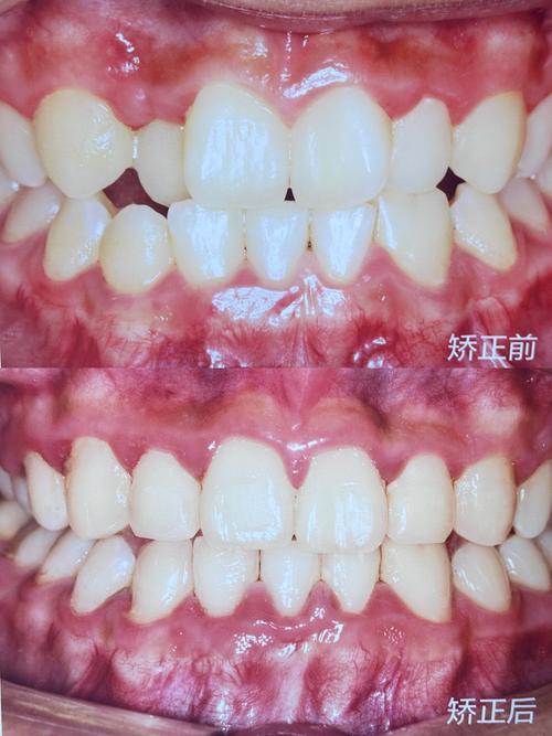 看完矫正牙齿前后对比照片，你敢信这是同一个人吗？-图1
