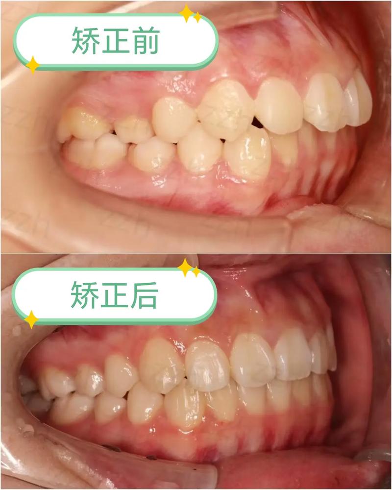 看完矫正牙齿前后对比照片，你敢信这是同一个人吗？-图2