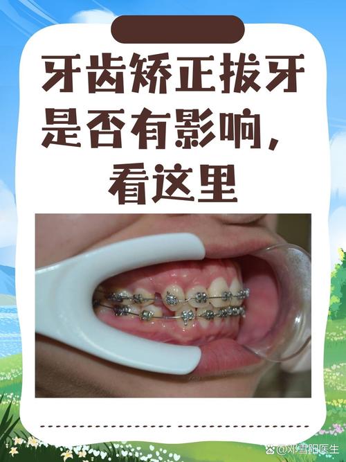 男孩矫正牙齿,拔牙是必须的吗?矫正效果会更好吗?-图1 男孩矫正牙齿,拔牙是必须的吗?矫正效果会更好吗?-图1