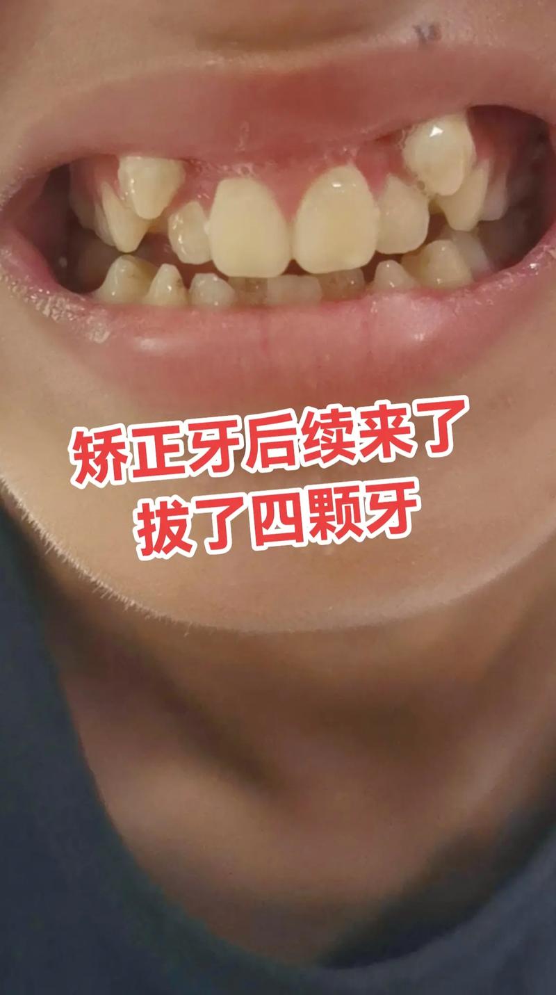 矫正牙齿一般拔哪颗牙-图3