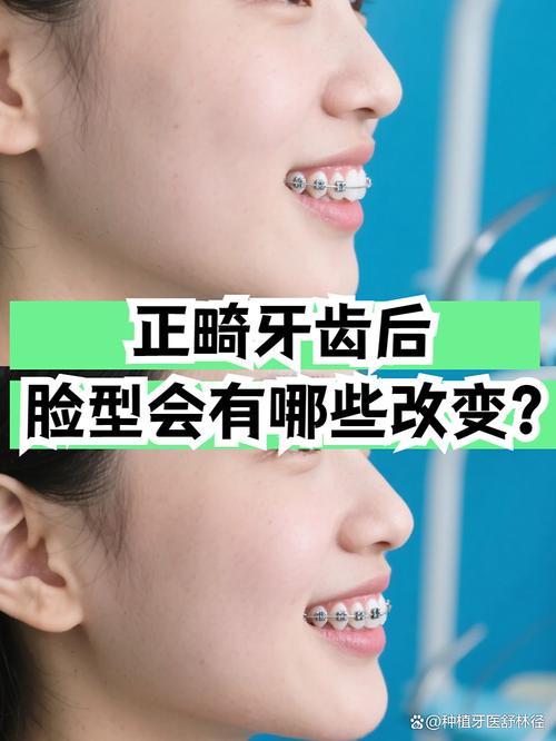 牙齿矫正对脸型的影响有多大？真能改变脸型吗？具体会有哪些变化？-图1
