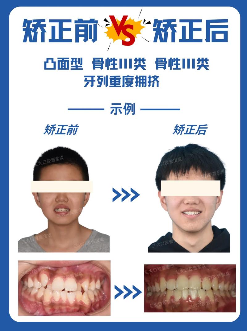 牙齿矫正对脸型的影响有多大？真能改变脸型吗？具体会有哪些变化？-图2