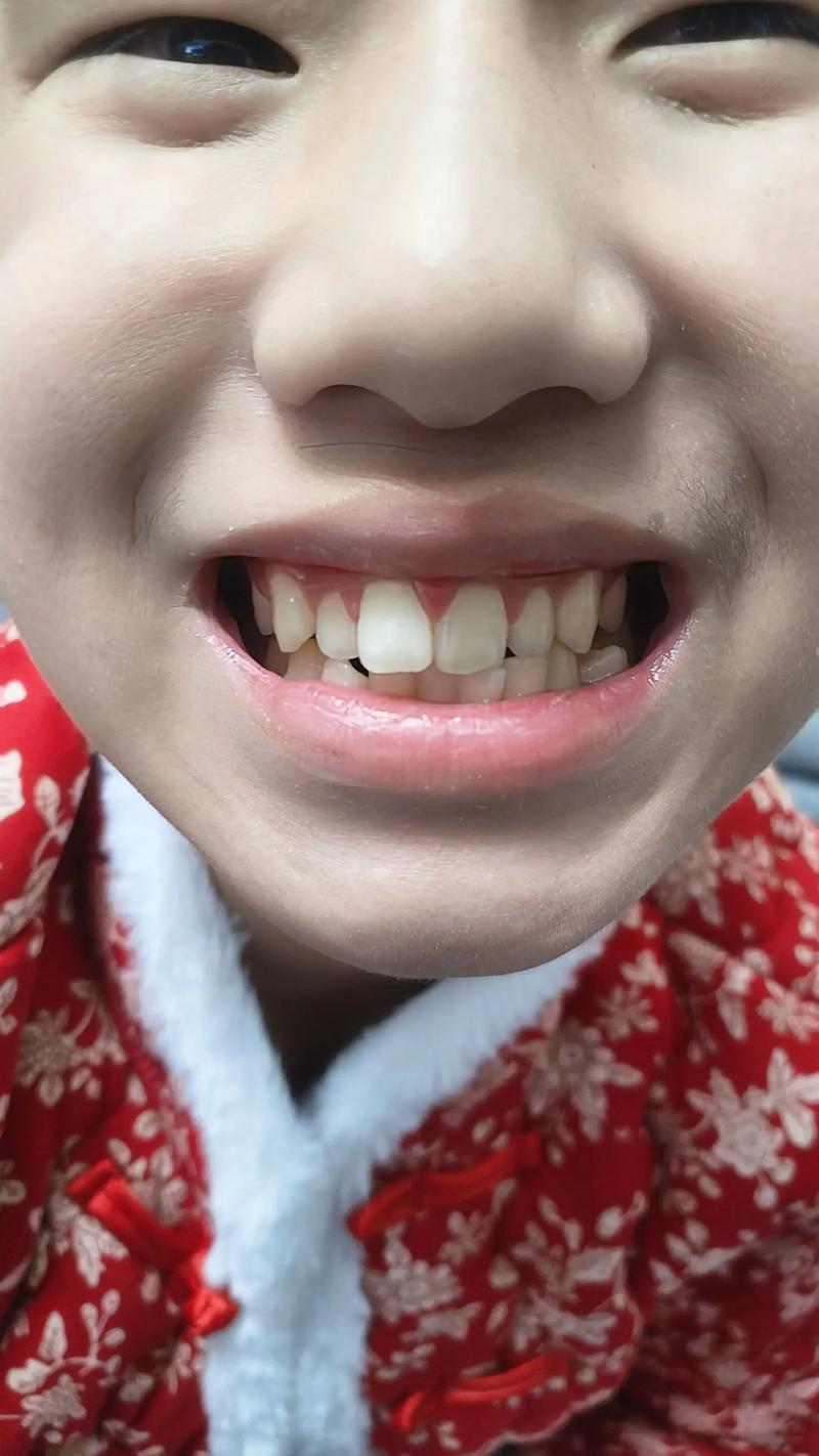 17岁矫正牙齿一般需要多长时间？-图3