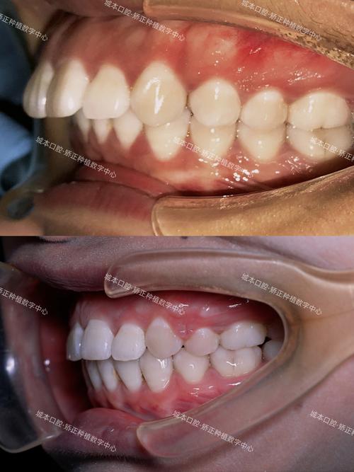 矫正牙齿能改变凸嘴吗？效果取决于牙齿和骨骼情况-图2