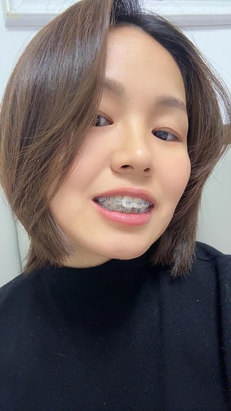 23岁矫正牙齿晚不晚-图1
