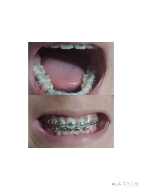 矫正牙齿可以拔门牙吗-图3