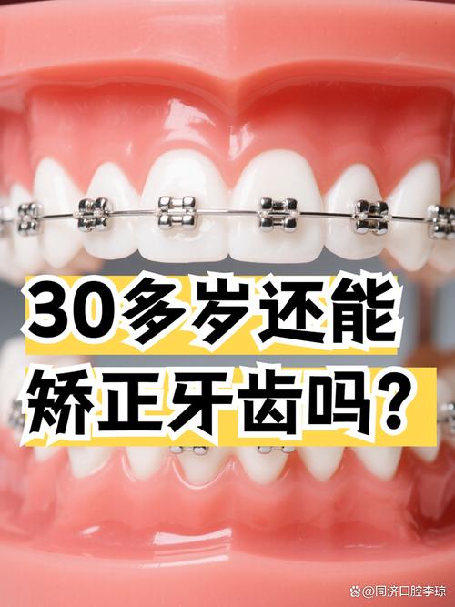三十岁矫正牙齿还来得及吗?-图1 三十岁矫正牙齿还来得及吗?-图1