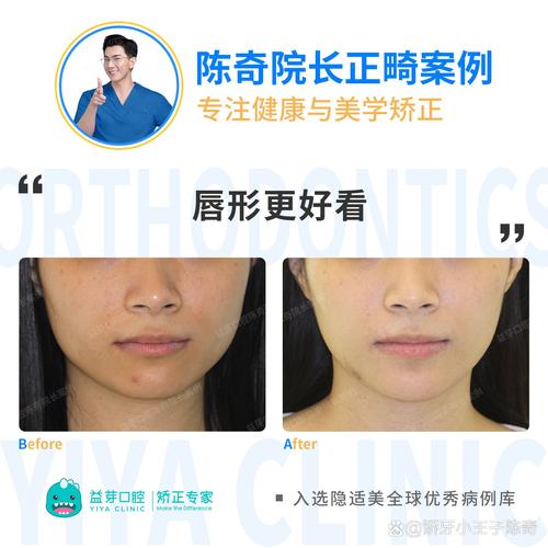 33岁矫正牙齿还来得及吗？成年人矫正可行性如何？-图3