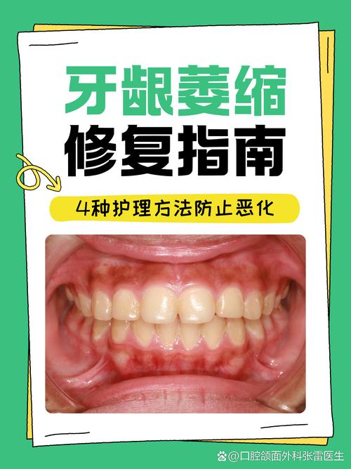 矫正牙齿真的会导致牙龈萎缩吗？-图2