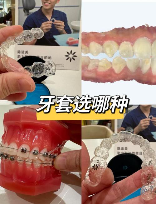 隐形牙齿矫正器有用吗？效果到底行不行？-图1