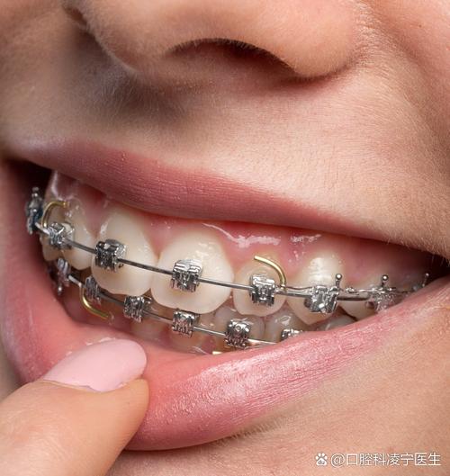 30岁矫正牙齿还来得及吗？-图2