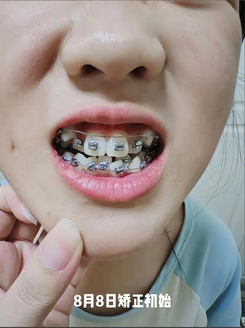 矫正牙齿500元(-图3