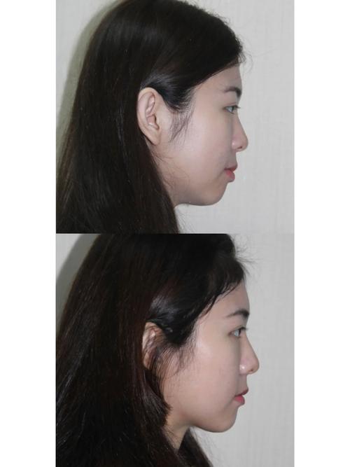 矫正牙齿后，侧面会变好看吗？-图1