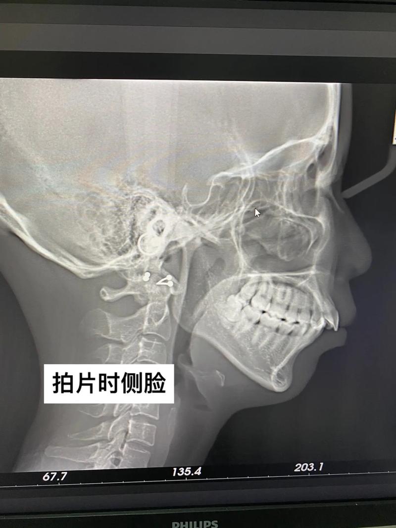 矫正牙齿后，侧面会变好看吗？-图2