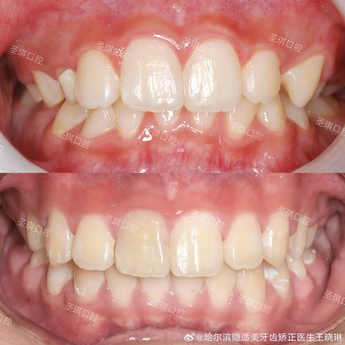 哈尔滨矫正牙齿哪家医院效果最好？-图3