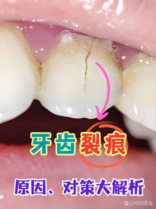 牙齿矫正为何会导致牙隐裂？矫正过程存哪些隐患？-图3