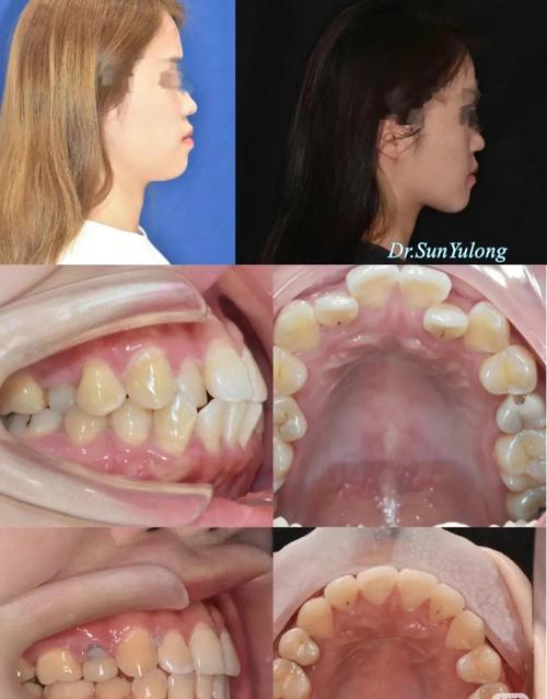 牙齿矫正拔牙太多？拔牙数量是否过度影响口腔健康？-图1