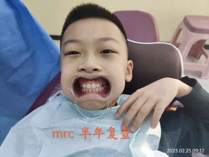 杭州MRC牙齿矫正效果好吗？适合哪些人？价格贵吗？体验如何？-图3