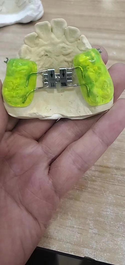 杭州MRC牙齿矫正效果好吗？适合哪些人？价格贵吗？体验如何？-图2