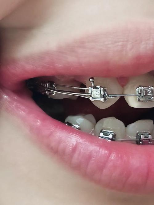 矫正牙齿能关闭牙缝吗？具体方法和效果如何？-图2