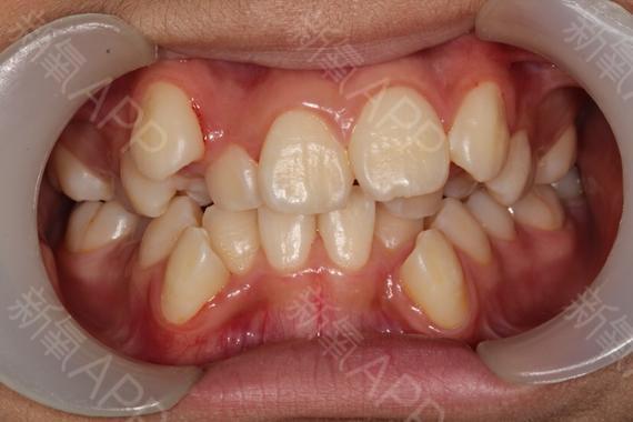 摩尔齿科牙齿矫正效果如何？价格和时间靠谱吗？-图2