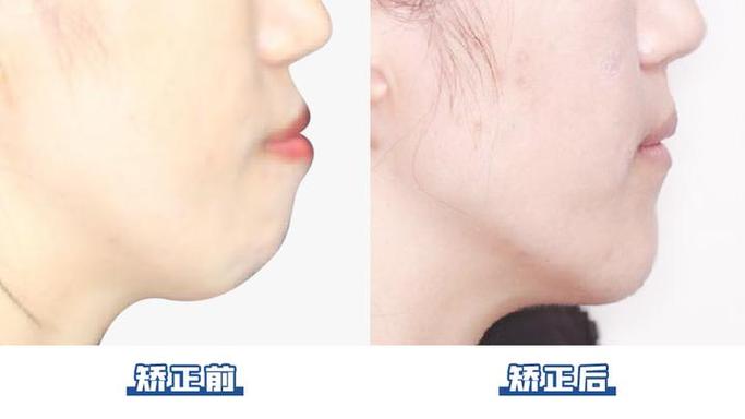 北京301医院牙齿矫正效果怎么样?价格贵吗?-图2 北京301医院牙齿矫正效果怎么样?价格贵吗?-图2