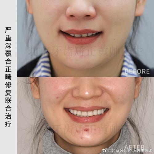 北京301医院牙齿矫正效果怎么样?价格贵吗?-图3 北京301医院牙齿矫正效果怎么样?价格贵吗?-图3