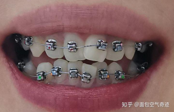 光华口腔矫正牙齿效果怎么样？好不好做？价格贵不贵？-图1