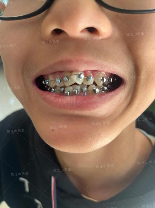 牙齿矫正，钢牙套和隐形到底该怎么选？纠结怎么选才合适？-图2