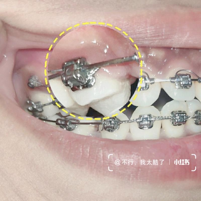 牙齿矫正粘接剂去除有哪些注意事项？-图3