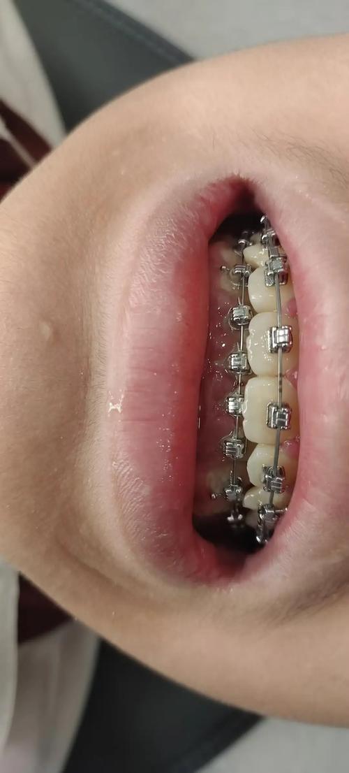 孩子牙齿矫正效果如何？能维持多久？有哪些影响因素？-图3