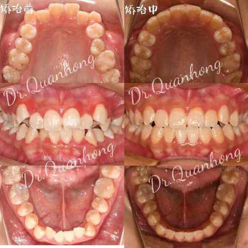 矫正牙齿后皮肤松弛，是矫正导致的吗？-图2