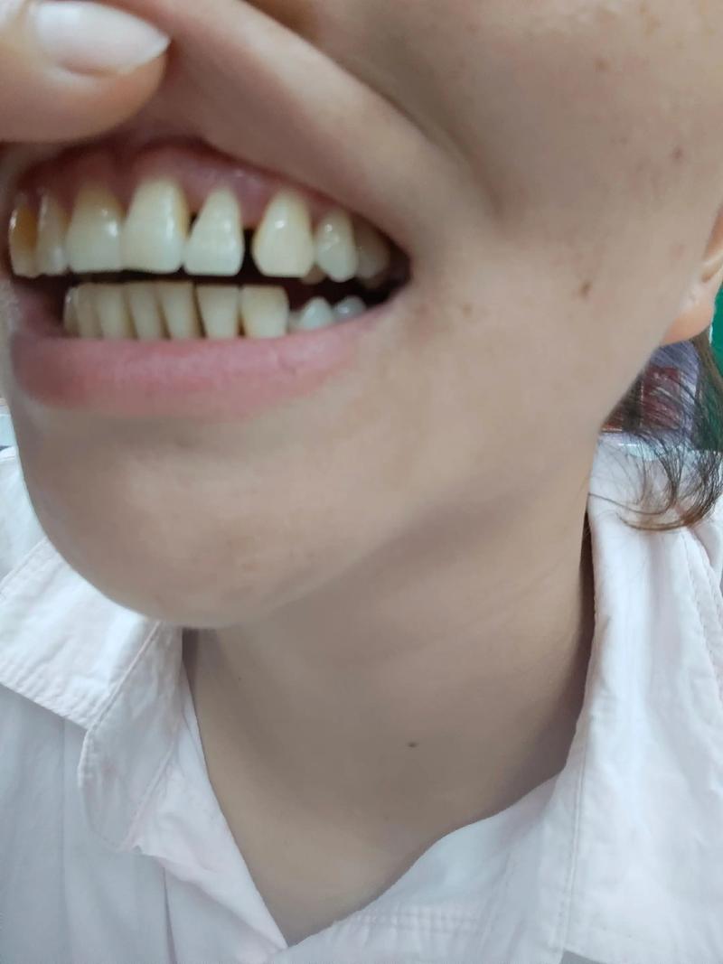 矫正牙齿后皮肤松弛，是矫正导致的吗？-图3