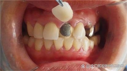 牙齿矫正托槽部分掉落，是什么原因导致的？-图1