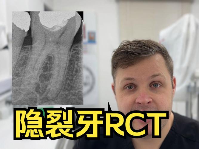 牙齿矫正会导致牙隐裂吗？图片解析原因与应对-图1