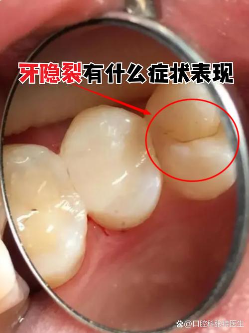 牙齿矫正会导致牙隐裂吗？图片解析原因与应对-图2