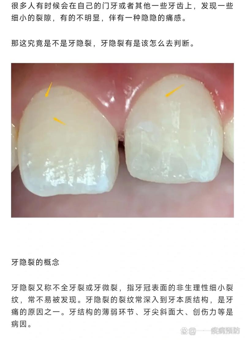 牙齿矫正会导致牙隐裂吗？图片解析原因与应对-图3